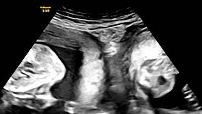 Woman with rare double uterus gives birth to twins - edition.cnn.com - China - province Shaanxi